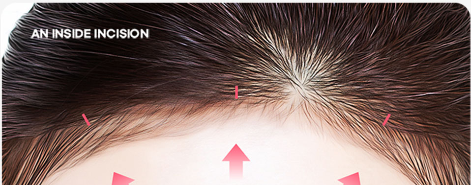 Cận cảnh vùng trán cho thấy vị trí rạch bên trong đường chân tóc — AN INSIDE INCISION