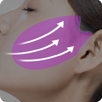 Nâng lớp SMAS