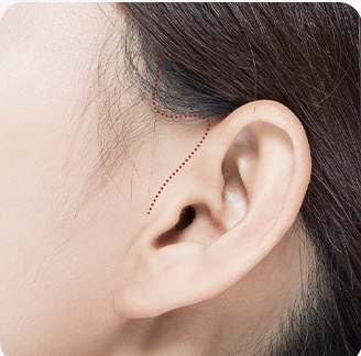 Khâu vùng rạch — hoàn tất phẫu thuật