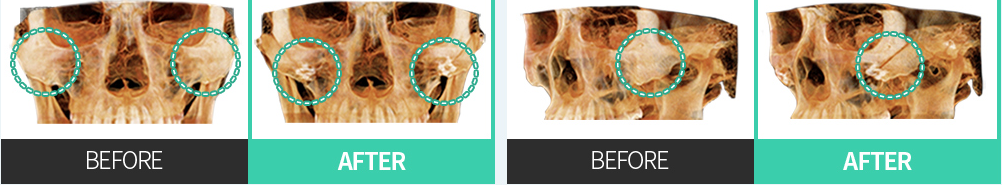 CASE 02 tái định vị về phía sau-trên — so sánh CT chính diện và nghiêng BEFORE / AFTER