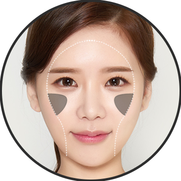 Thể tích — cấy mỡ gò má trước + thu nhỏ gò má bên