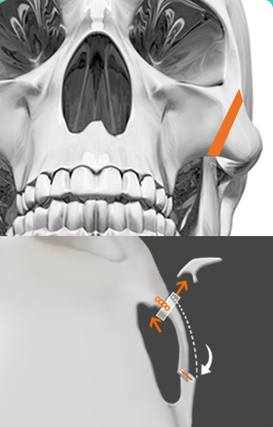 Cắt bỏ — sơ đồ cắt bỏ một phần xương gò má (CT chính diện và nghiêng)