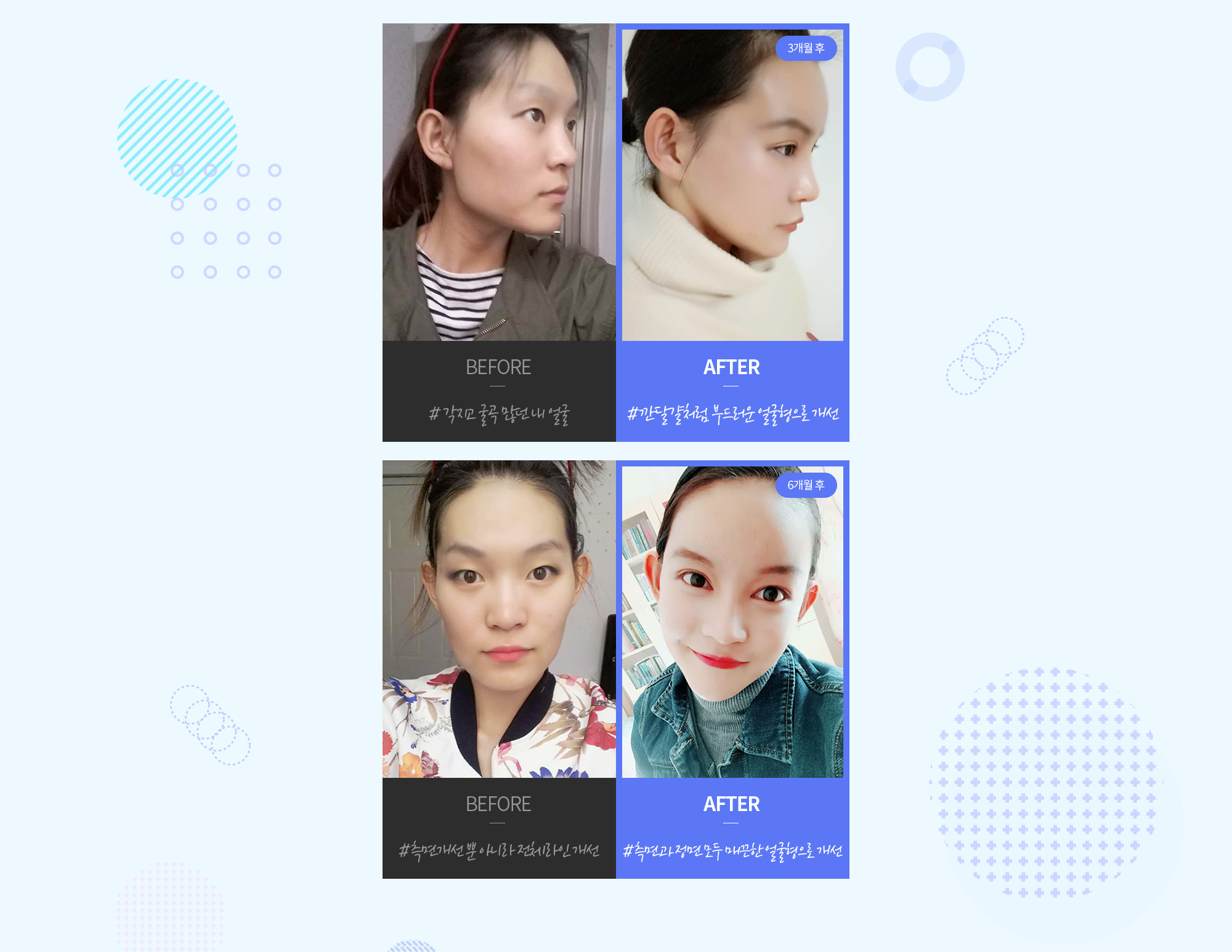 Phẫu thuật thu nhỏ gò má Thẩm mỹ Hyundai REAL ảnh trước sau — CASE 1: chính diện và nghiêng BEFORE/AFTER (#khuôn mặt góc cạnh, nhiều đường gấp → #cải thiện thành dáng mặt mềm mại như trứng bóc vỏ, sau 6 tháng). CASE 2: chính diện và nghiêng BEFORE/AFTER (#không chỉ cải thiện góc nghiêng mà còn cải thiện toàn bộ đường nét → #cải thiện thành dáng mặt mượt mà cả góc nghiêng lẫn chính diện, sau 6 tháng).