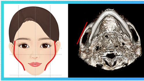 Kiểu gò má bên nhô — sơ đồ gò má + CT