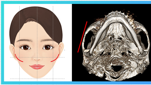 Kiểu gò má 45 độ nhô — sơ đồ gò má + CT