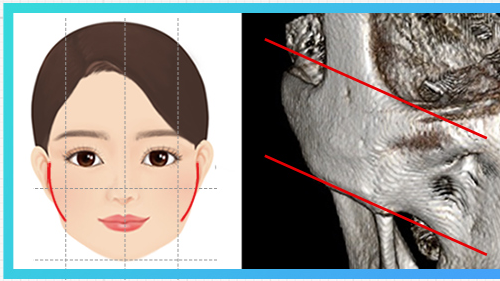 Kiểu toàn bộ gò má rộng — sơ đồ gò má + CT