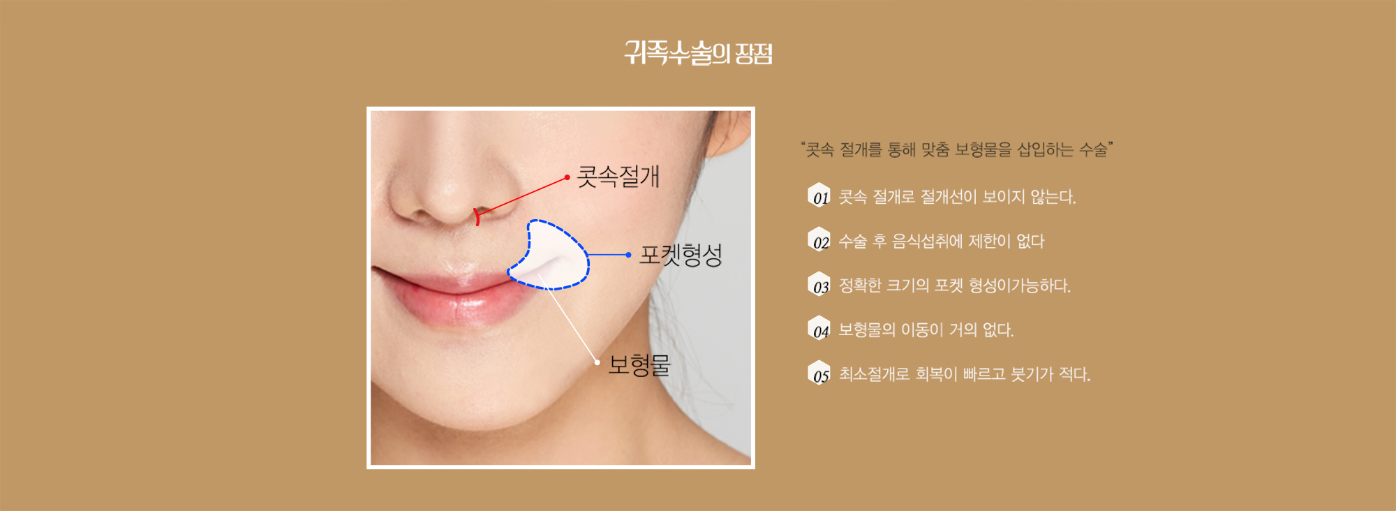 Ưu điểm của phẫu thuật quý tộc — sơ đồ đường rạch trong mũi, tạo khoang, vật liệu độn và năm ưu điểm