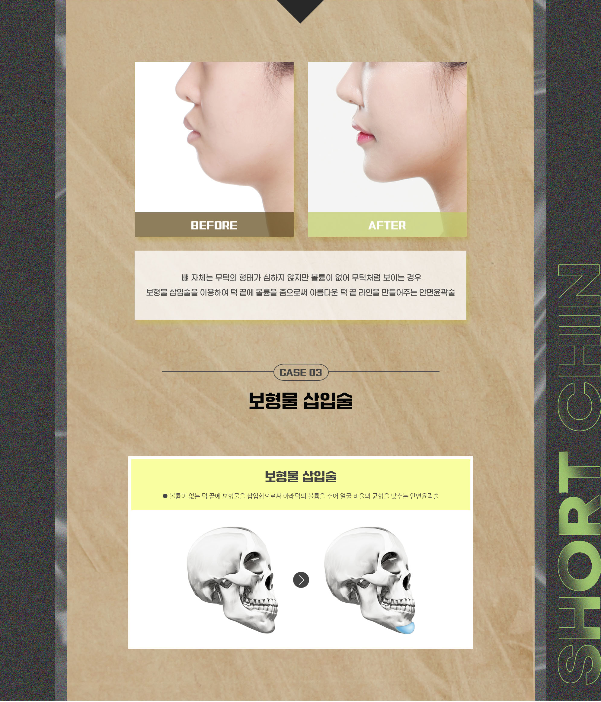 CASE 03 Thiếu độ đầy và cằm lẹm — hình ảnh trước sau phẫu thuật và hướng dẫn đặt vật liệu độn