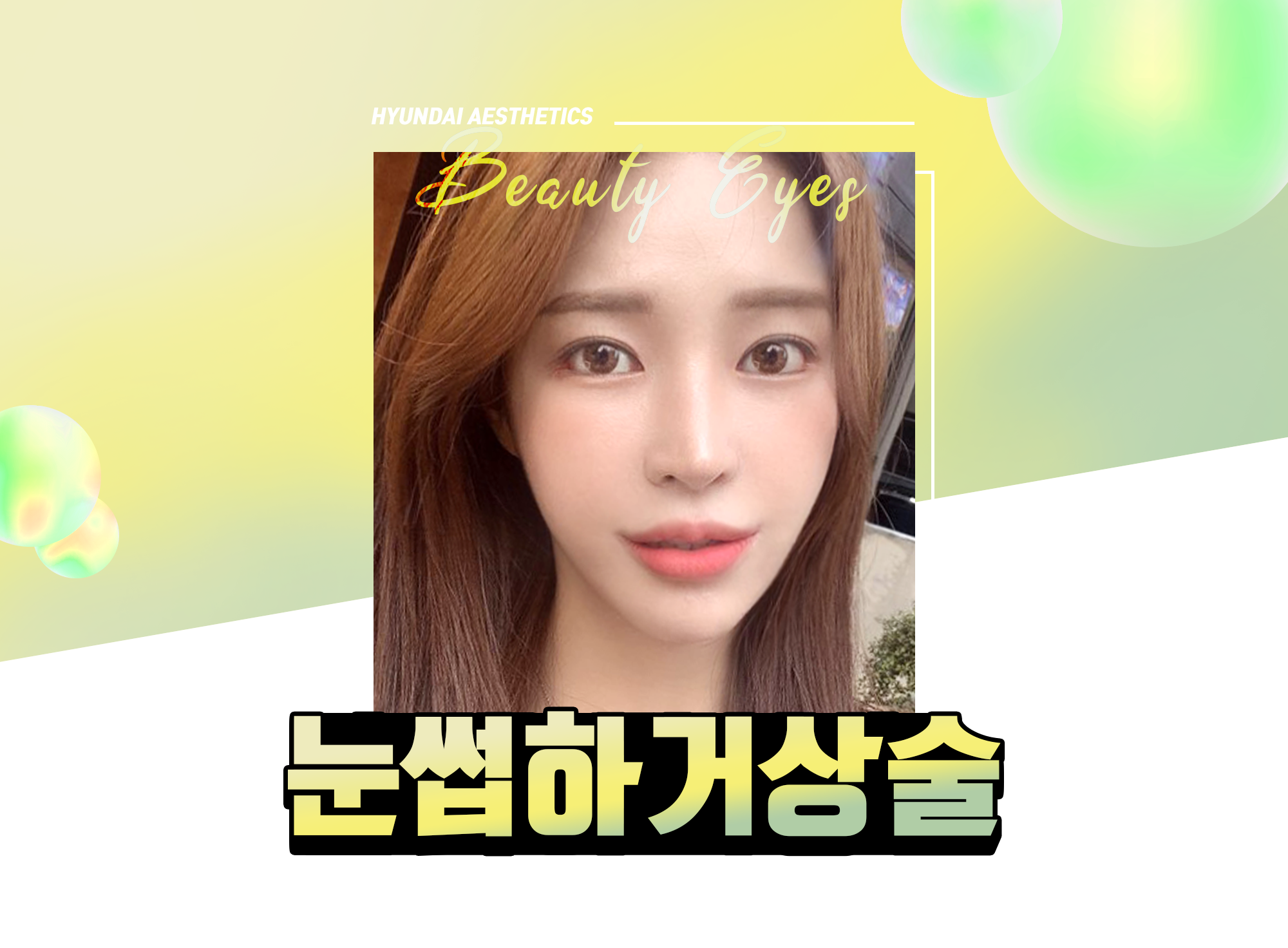 Nâng chân mày Thẩm mỹ Hyundai — HYUNDAI AESTHETICS Beauty Eyes, ảnh người mẫu phẫu thuật nâng chân mày dưới