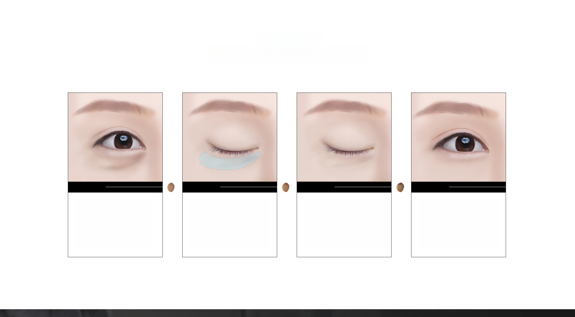 4 sơ đồ mắt minh họa STEP 4 bước của phẫu thuật mí dưới