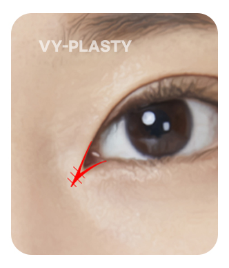 Hình minh họa vạt V-Y