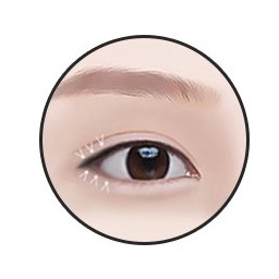 Hạ mí dưới bước 3 — khâu không lộ sẹo