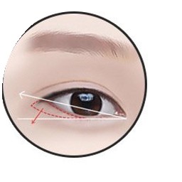 Mở đuôi mắt bước 2 - chẩn đoán và thiết kế chiều dài đường rạch