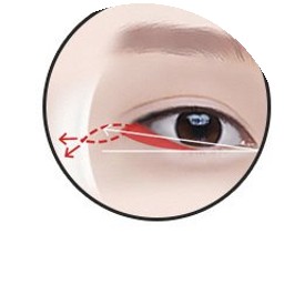 Mở đuôi mắt bước 3 - cố định màng xương góc mắt ngoài