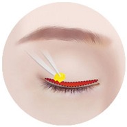 Minh họa STEP 02 giai đoạn cắt bỏ trong phẫu thuật cắt mí