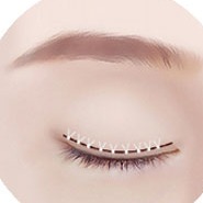 Minh họa STEP 03 giai đoạn cố định và khâu trong phẫu thuật cắt mí