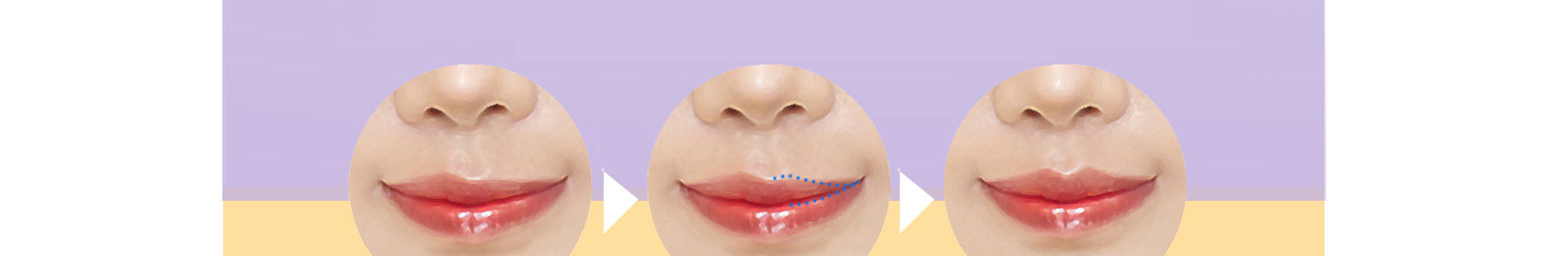 Trước và sau khi chỉnh sửa bất đối xứng đỉnh môi / viền môi