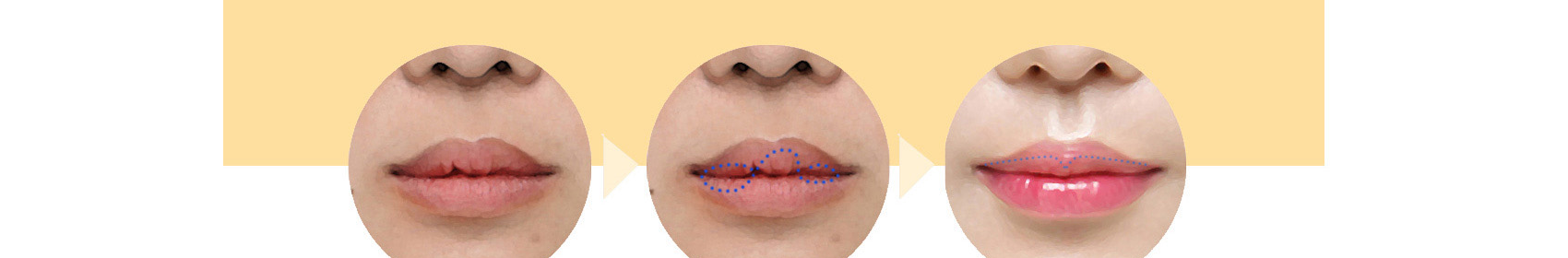 Trước và sau khi chỉnh sửa bất đối xứng niêm mạc môi