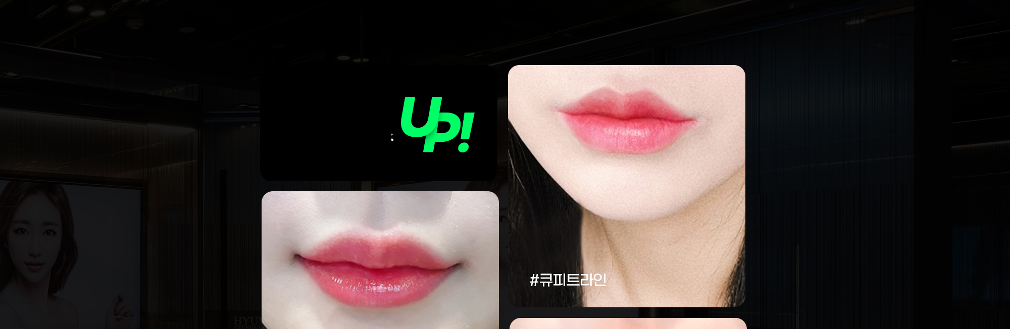 Ảnh môi trước và sau phẫu thuật môi Cupid line