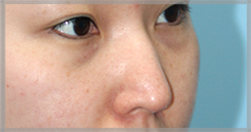 Trước phẫu thuật chỉnh mũi đầu chúi — ảnh nghiêng của mũi (BEFORE)
