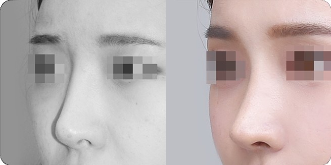 So sánh góc nghiêng trước và sau nâng mũi không vật liệu nhân tạo 2 (BEFORE / AFTER 3MONTH)