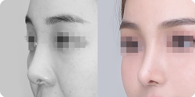 So sánh góc nghiêng trước và sau nâng mũi không vật liệu nhân tạo 3 (BEFORE / AFTER 3MONTH)