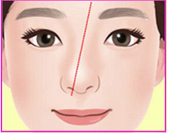 Minh họa mũi lệch dạng xiên