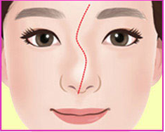 Minh họa mũi lệch dạng S