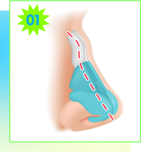 Sơ đồ phẫu thuật trường hợp xương mũi bị lệch