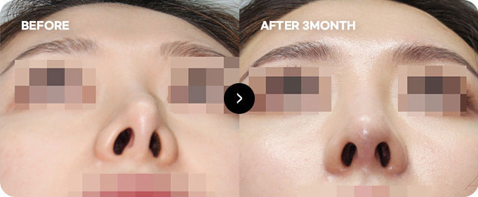 Trước và sau chỉnh sửa lại mũi bị lệch do phẫu thuật & dính da 2
