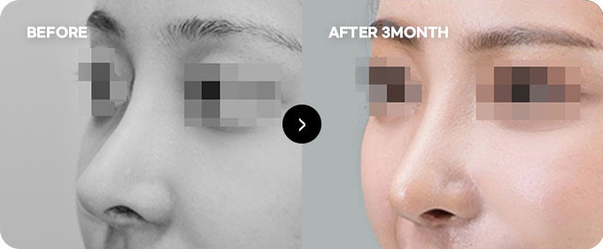 Trước và sau chỉnh sửa lại đường nét đầu mũi 1