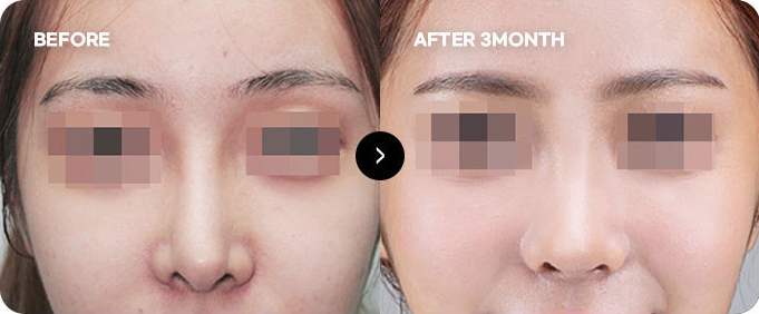 Trước và sau chỉnh sửa lại đường nét đầu mũi 2